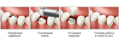 Зубные коронки – простое решение  непростых проблем